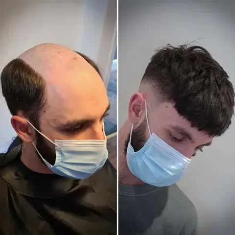Antes y después de una prótesis capilar: a la izquierda un hombre con calvicie en la coronilla, a la derecha el mismo hombre con cabello corto y abundante